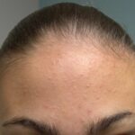 Mụn Ẩn là gì? Nguyên nhân và Cách trị mụn ẩn dưới da hiệu quả