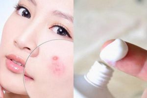 cách trị mụn đầu đen bằng kem đánh răng