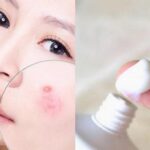 Cách trị mụn đầu đen bằng Kem Đánh Răng đơn giản tại nhà