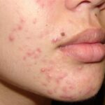 Mụn bọc là gì? Cách trị mụn trứng cá bọc tại nhà Nhanh Nhất