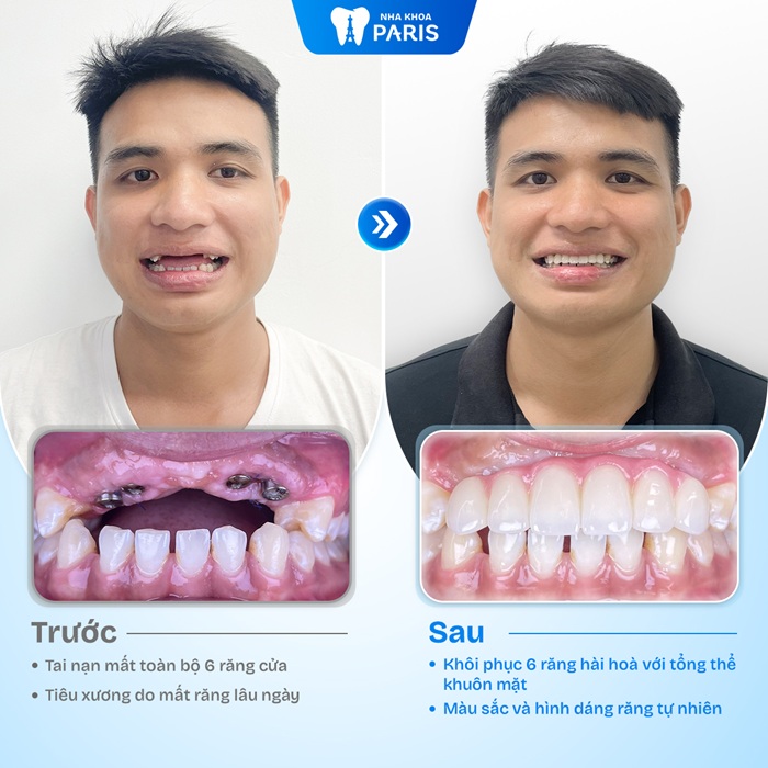 Trồng răng cửa Implant an toàn, đảm bảo ăn nhai tốt