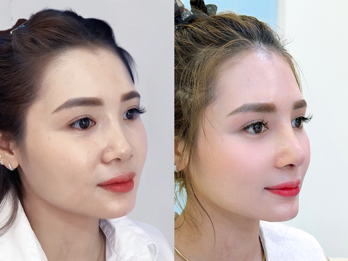 khách hàng nâng mũi sau 2 năm vẫn ổn định