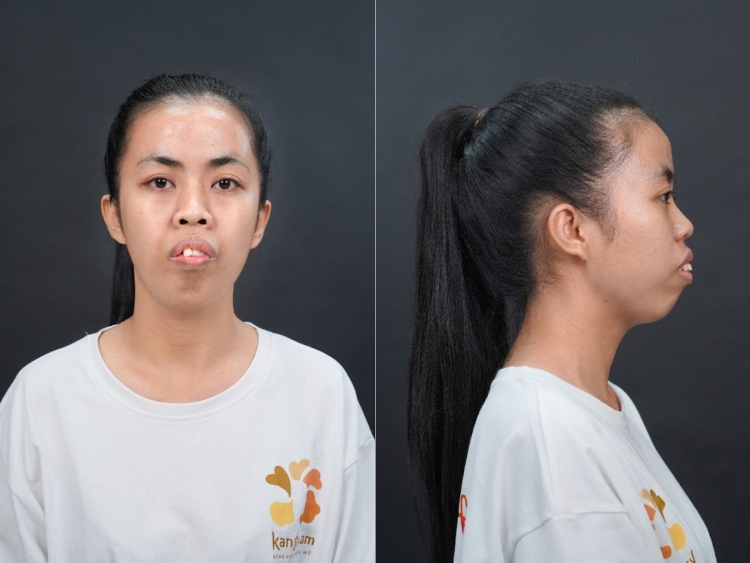 Tình trạng gương mặt và mí mắt của My trước phẫu thuật