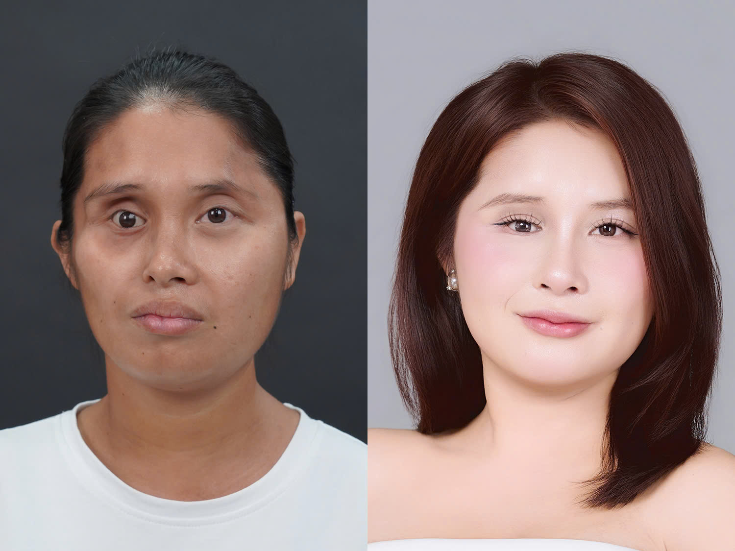 Yến sở hữu gương mặt cân đối, đôi mắt to sáng và đều sau phẫu thuật