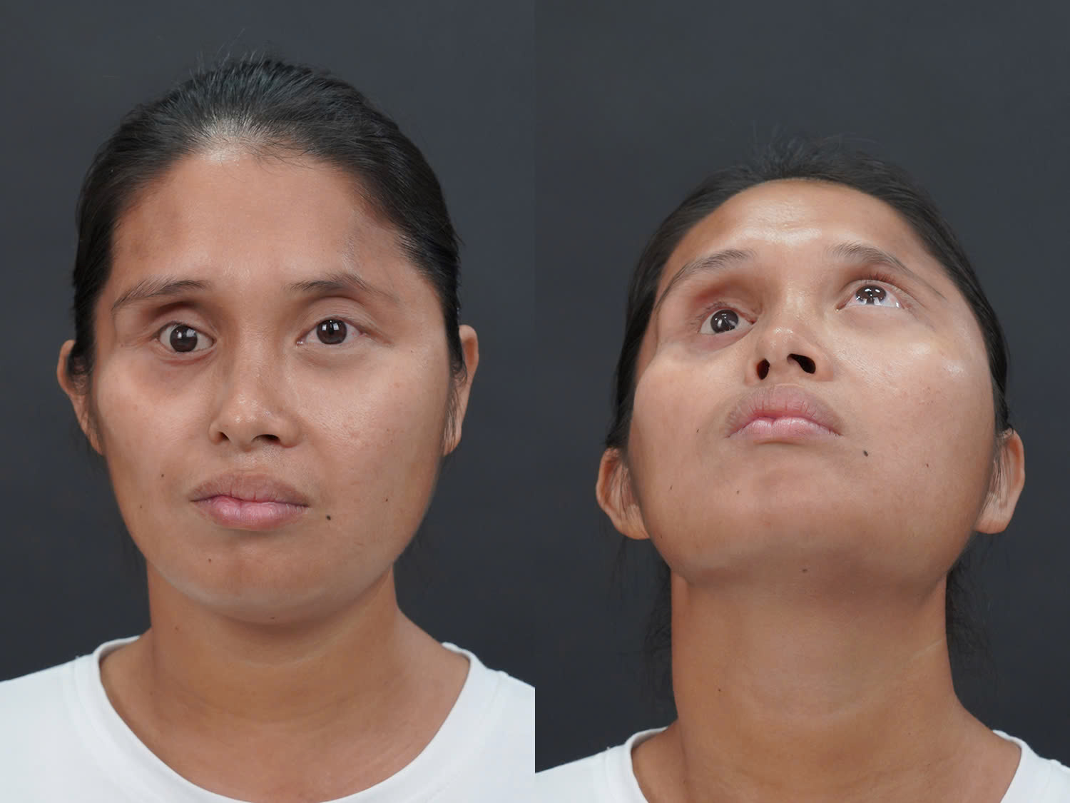 Tình trạng mất cân đối 2 bên cơ thể của Yến